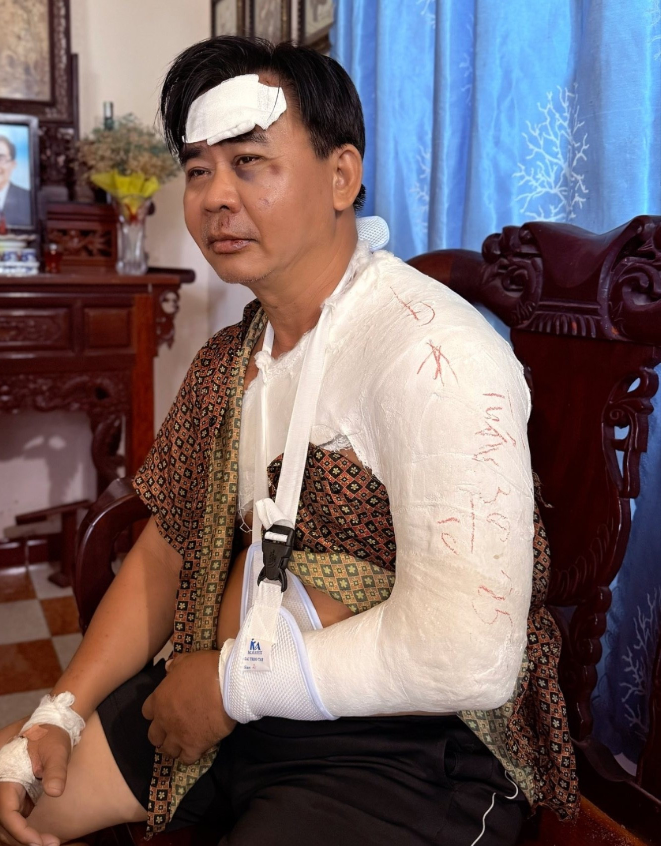 Nghệ sĩ Chánh Thuận bị bó bột sau tai nạn