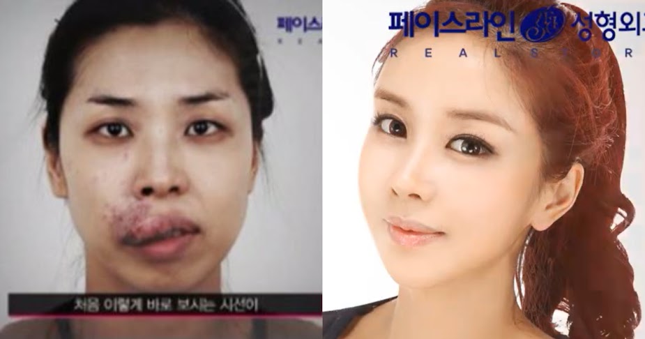 Kim Hee Eun trước và sau phẫu thuật
